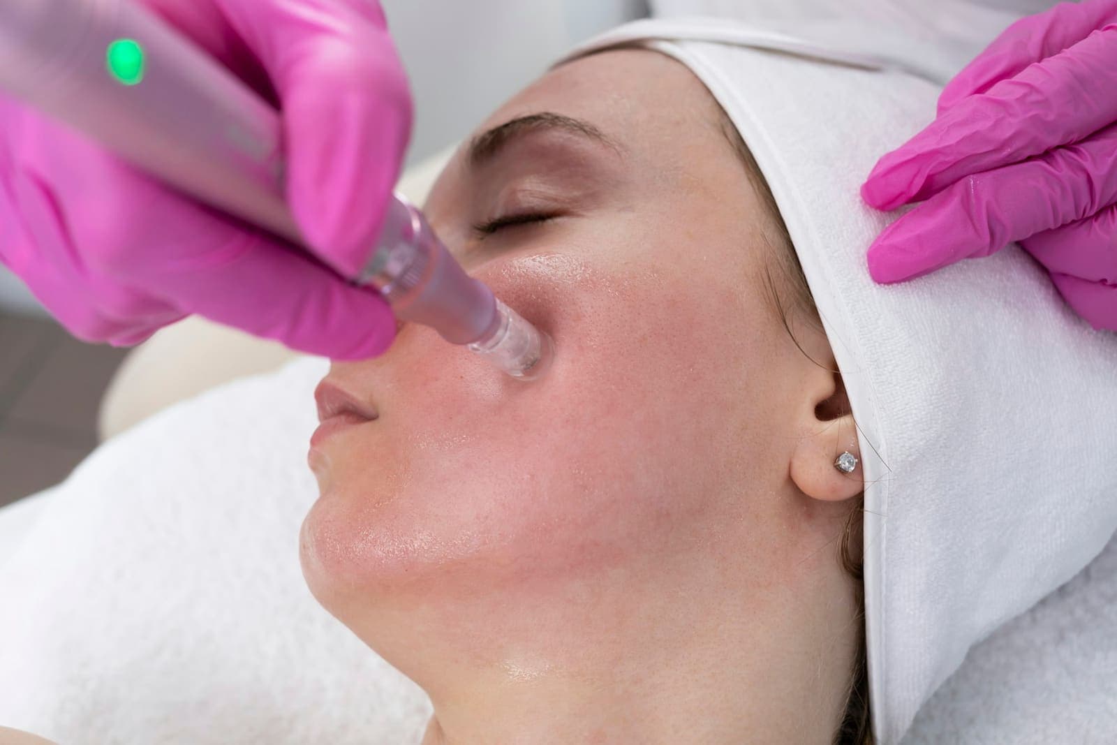 Client receiving a microneedling facial